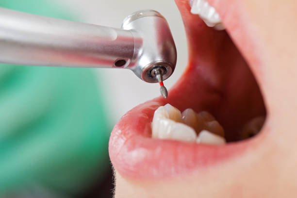 Best Broken or Cracked Tooth Emergency Dentist in Mango, FL